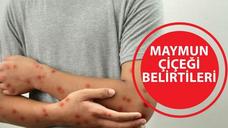 MAYMUN ÇİÇEĞİ BELİRTİLERİ: Maymun çiçeği virüsü öldürür mü? Nasıl bulaşır? Maymun çiçeği Türkiye’de görüldü mü?