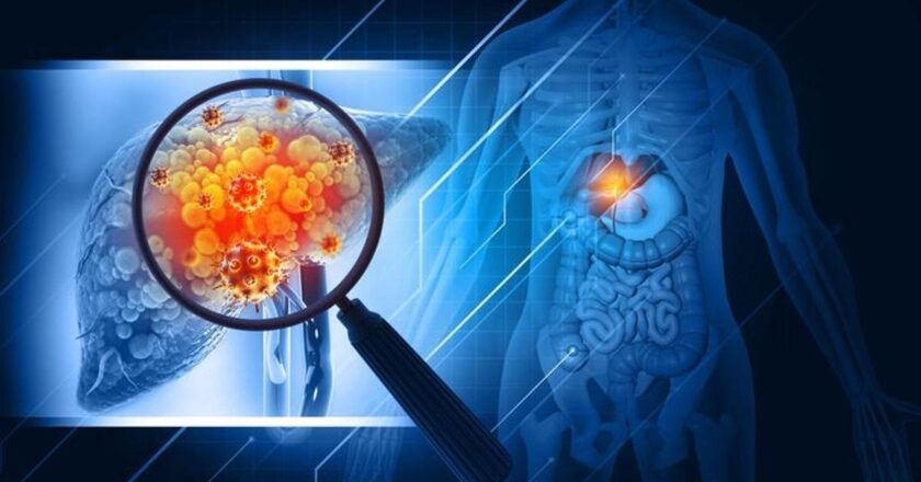 Karaciğer kanseri belirtileri nelerdir? Karaciğer Kanseri Nasıl Anlanır? Tedavi yöntemleri nelerdir?